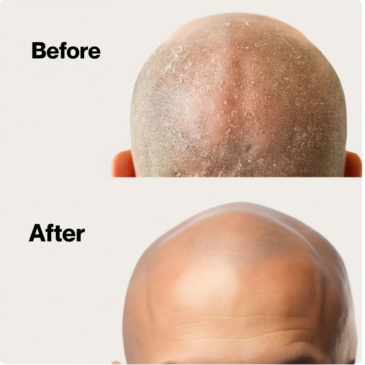 Hoofdhuidpeeling met panthenol en vitamine E